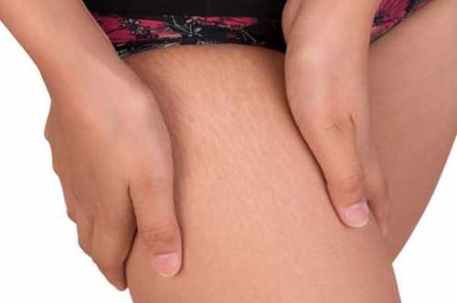 растяжки на теле: терминология, причины появления и способы избавления растяжки на теле: терминология, причины появления и способы избавления